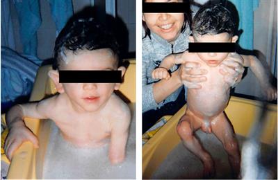 Is it possible to achieve an acceptable disease control by dietary therapy alone in Berardinelli Seip type 1? Experience from a case report